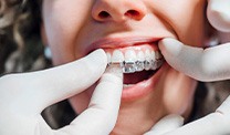 Dentist placing clear aligner on patient's teeth