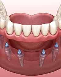 A 3D illustration of implant dentures