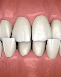 a computer illustration depicting crowded teeth