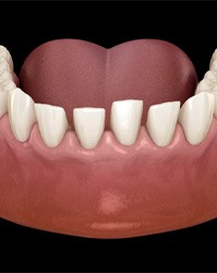 a computer illustration depicting misspaced teeth