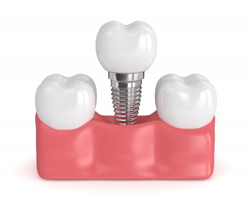 Failed Dental Implants in Belmont | Schrott Perio Implants