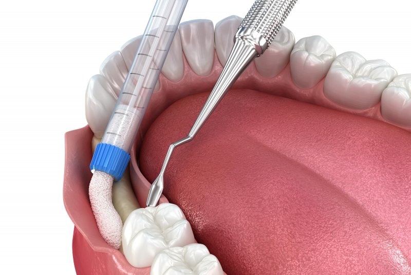 digital image of bone grafting